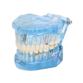   Fogmodell állkapocs fogak fog implantátumok - Fogorvosi modell állkapocs fogakkal és implantátumokkal