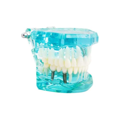 Fogmodell állkapocs fogak fog implantátumok - Fogorvosi modell állkapocs fogakkal és implantátumokkal