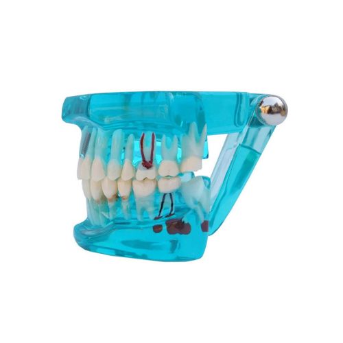 Fogmodell állkapocs fogak fog implantátumok - Fogorvosi modell állkapocs fogakkal és implantátumokkal